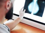 Nueva aplicacin del SES para realizar seguimiento programa de deteccin de cncer de mama