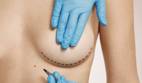 Mamoplastia claves y tendencias actuales