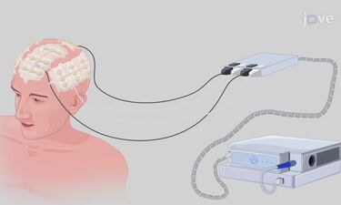 SES compra transductores para tratar con nueva terapia a pacientes con tumor cerebral