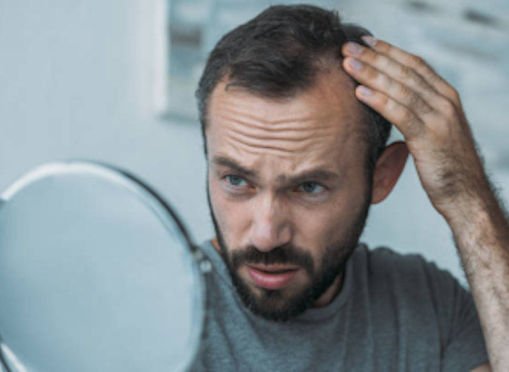 Injerto capilar por qu est creciendo tanto en Andaluca y Extremadura