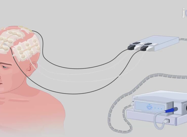 SES compra transductores para tratar con nueva terapia a pacientes con tumor cerebral