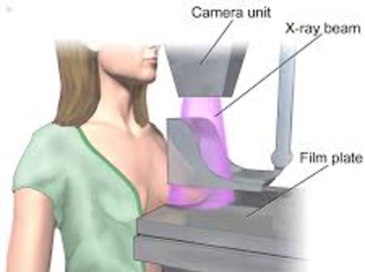 Unas 5000 extremeas se sometern a mamografas en diciembre