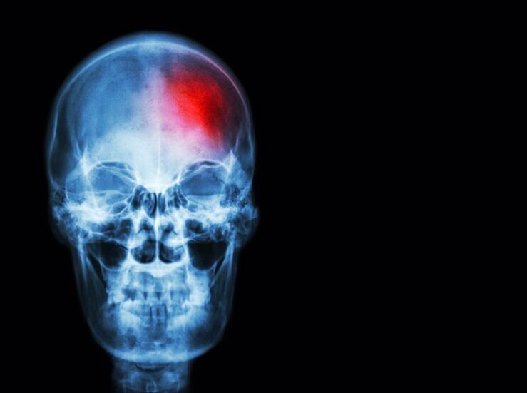 Colegio de Mdicos de Cceres organiza jornada divulgativa por el Da Mundial del Ictus
