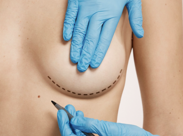 Mamoplastia claves y tendencias actuales