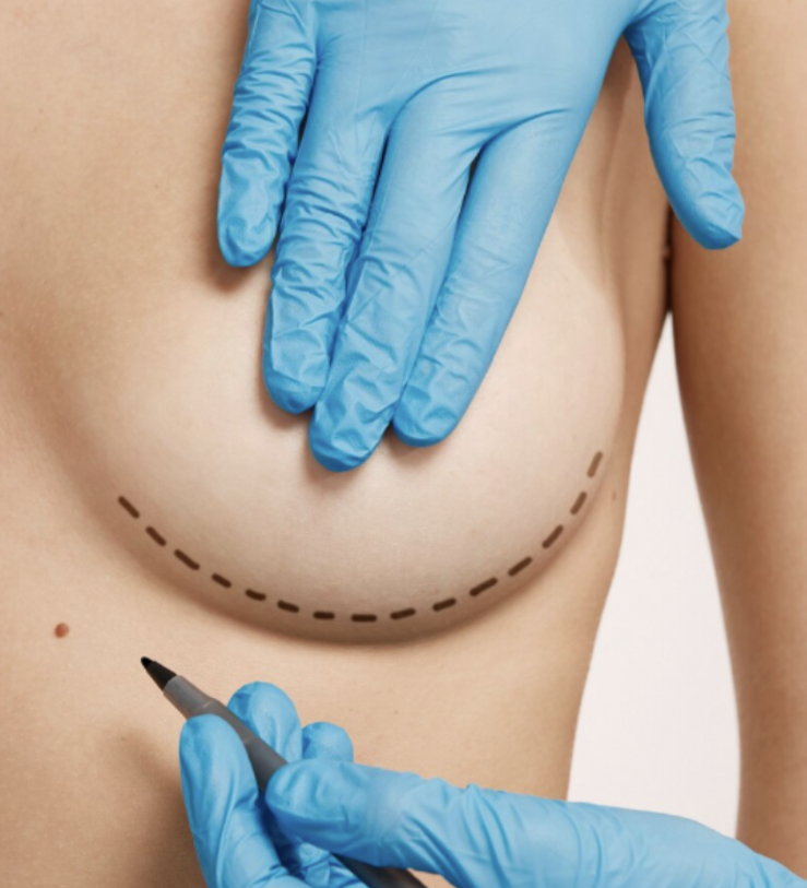 Mamoplastia claves y tendencias actuales
